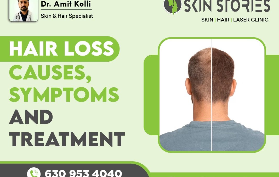 Hair Loss Causes, Symptoms and Treatment