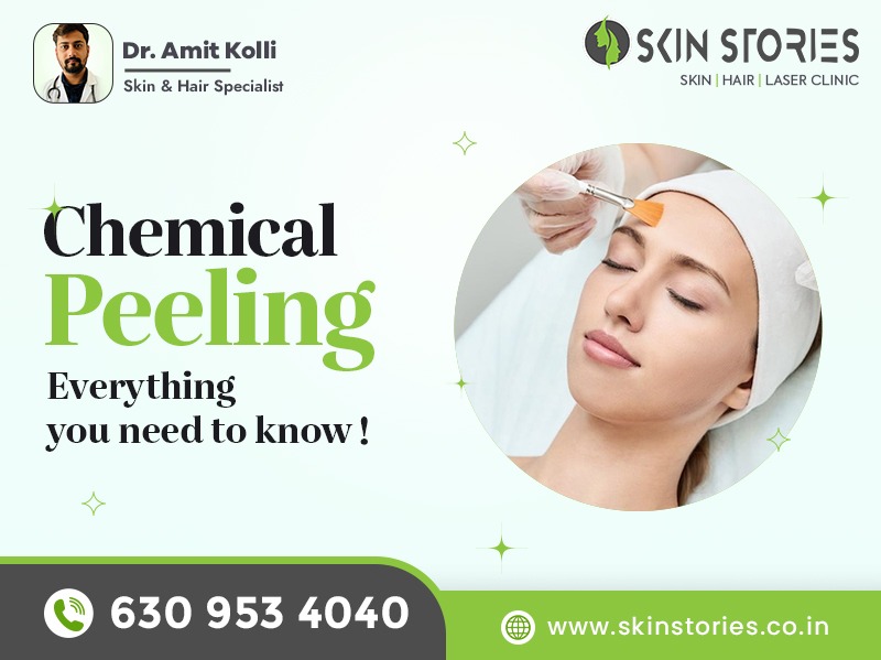 Chemical Peels